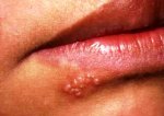 herpes-labialis-groznica-na-usnama